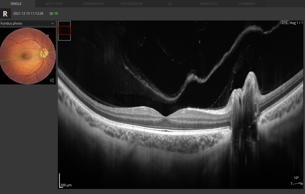 Retina B-scan Vue unique